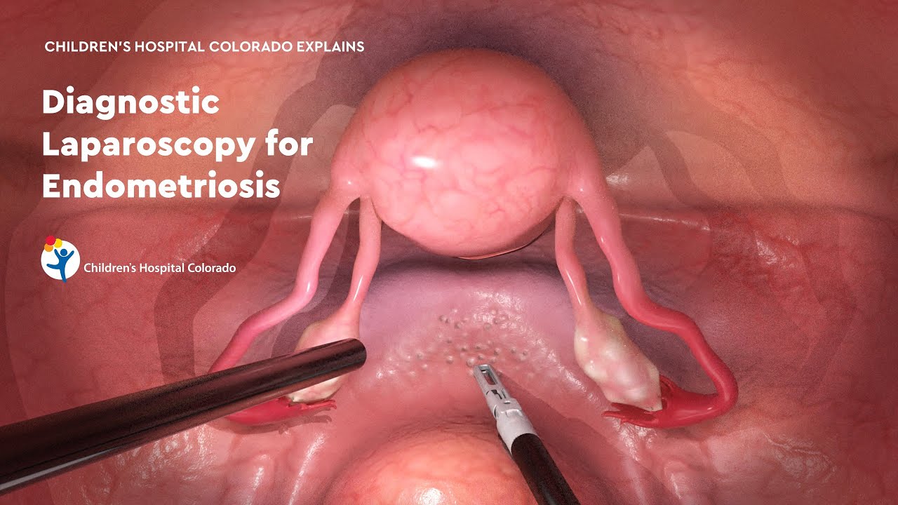 Diagnostic Laparoscopy for Endometriosis