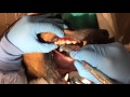 Dog Surgical Extraction Of Carnassial Tooth
