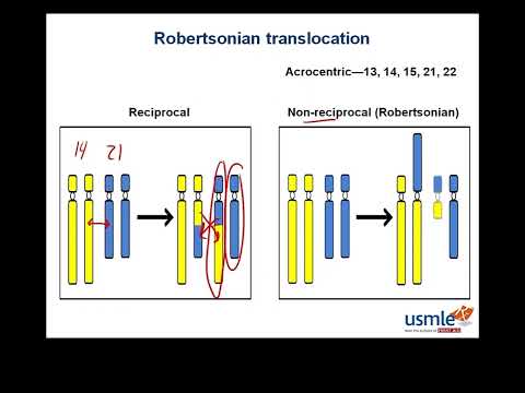 Robertsonian translocation USMLE Step 1