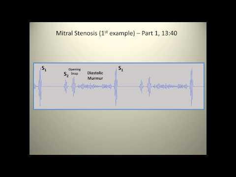 Mitral Stenosis | Rated Medicine