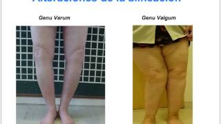 artrosis. Dr Francisco Blanco CHUAC A Coruña, Spain