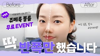 [이벤트] 쥬베룩 볼륨 왼쪽은 시술 X, 오른쪽은 시술 O 차이 확실하죠? #쥬베룩 #시술추천 #피부관리