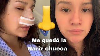 (RINOPLASTIA/SEPTOPLASTIA) me quedó CHUECA! Mi experiencia
