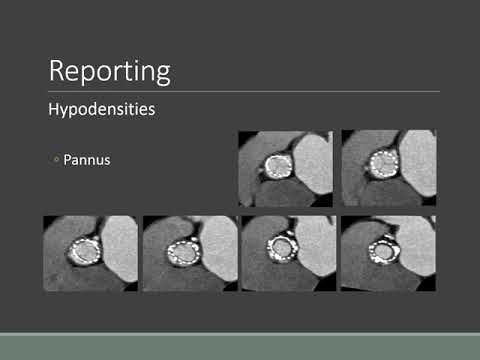 CT Imaging Post TAVI