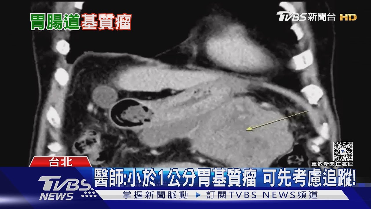 肚子痛、腹脹可能不是小病!小心「胃腸道基質瘤」作怪 不可輕忽!