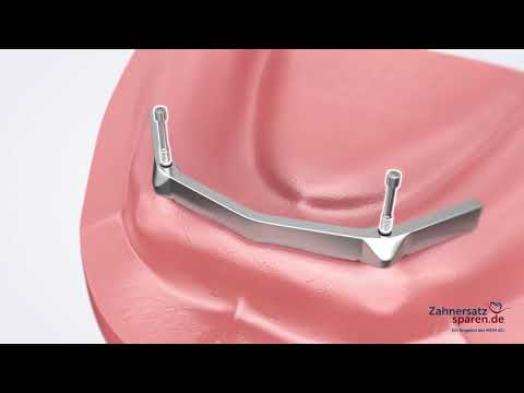 Behandlungsablauf: Stegprothese - Zahnersatzsparen.de