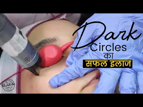 Dark Circles का सफल इलाज | Under Eye Dark Circle Treatment | Dadu Medical Centre