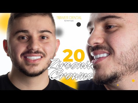 Hollywood Smile Transformation in Turkey: Rami El Sebai’s Dental Journey from Australia