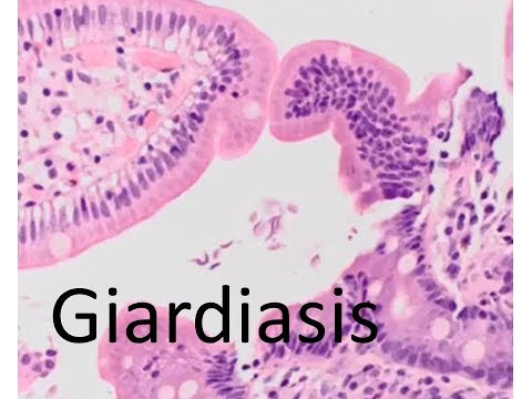 Giardiasis