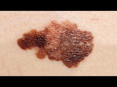 A Farmer Decided to Remove His Own Skin Cancer...