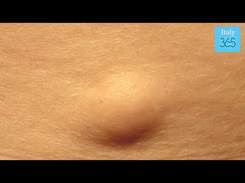 Osteocondrosi di un nodo alla gola con una mano Trattamento di osteocondrosi toracica