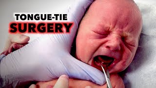 TONGUE-TIE SURGERY on NEWBORN  (Frenotomy) | Dr. Paul