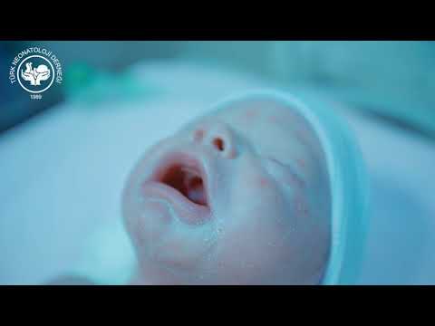 Solunum sıkıntısı olan yenidoğan