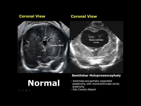 Fetal Brain Ultrasound Normal Vs Abnormal Image Appearances Comparison | Fetal Brain Pathologies USG