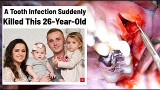 A Tooth Infection Can Be Deadly ☠️Dental Abscess Pus Drainage