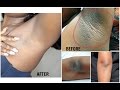 HOW TO LIGHTEN DARK UNDERARM  NATURALLY AND FAST |  PERMANENT RESULTS