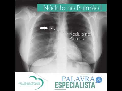 Nódulo no pulmão, o que é?⁣