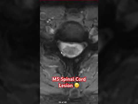 MS Spinal Cord Lesion ☹️