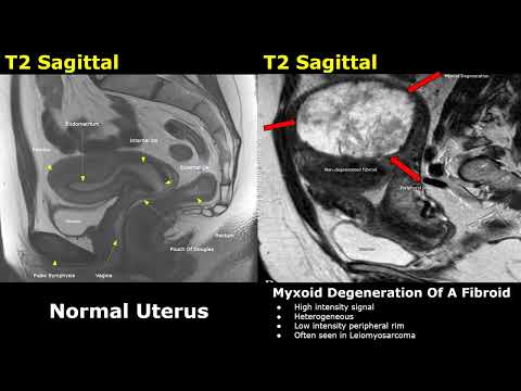 Uterus MRI Normal Vs Abnormal Images | Uterine & Cervix Pathologies | Cancer Staging | Gynecology