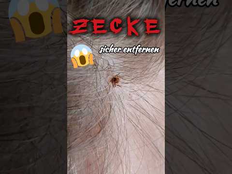 Zecken richtig entfernen