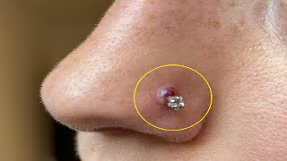 how to get rid of nose piercing bump fast without sea salt