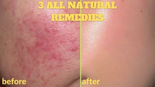 HOW TO GET RID OF ACNE + SCARS OVERNIGHT | 3 DIY HOME REMEDIES + ALL NATURAL FACE MASKS [100% Works]