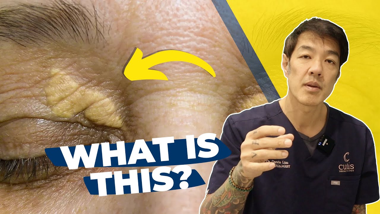 How to treat Xanthelasma | Dr Davin Lim