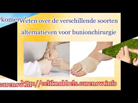 Hoe ik mijn bunion heb genezen