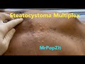 Steatocystoma Multiplex. Dozens of extractions on the chest. Chronic condition. MrPopZit.