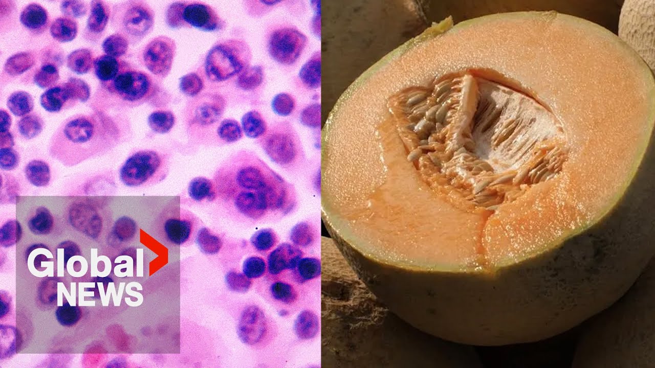 Salmonella poisoning symptoms: What to watch out for as cantaloupe-linked outbreak kills 5 in Canada