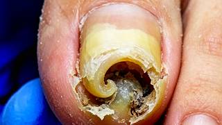 Ingrown Nails Curled Like Horns, Carefully Trimmed~【Xue Yidao】