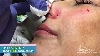 Facial Vein Removal Using Radio Frequency - Reno Sparks MedSpa - Dr. Calvin Van Reken