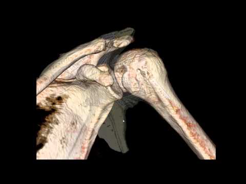 Posterior Shoulder Dislocation