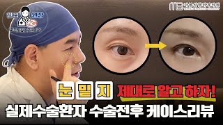[성형외과전문의] 무조건 10년 이상 젊어집니다;; 꺼진눈 + 눈밑지방 케이스리뷰