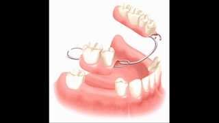 Dental Bridge , Treatment -Execudent