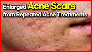 How to Boost Skin Immunity to Prevent Recurring Acne (Must-Watch if Acne Keeps Coming Back)