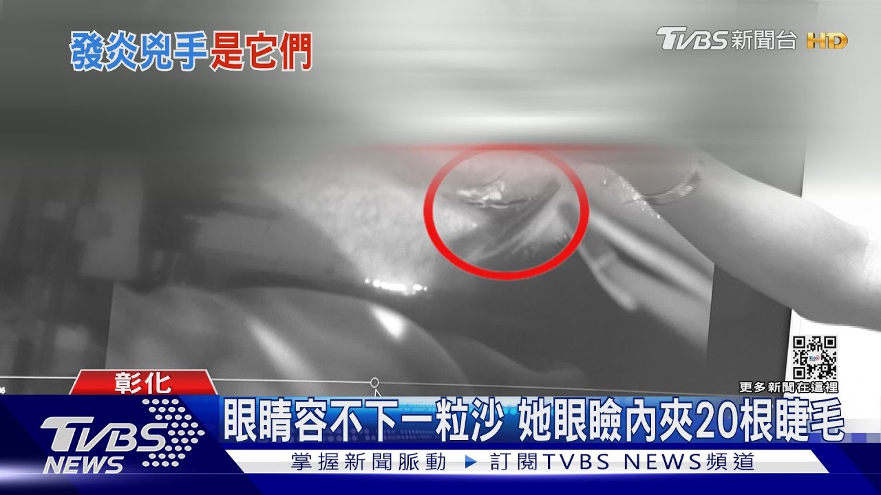 眼睛容不下一粒沙 她眼瞼內夾20根睫毛