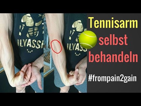 Tennisarm / Tennisellenbogen selbst behandeln - 3 Methoden die funktionieren!│Mischa Kotlyar