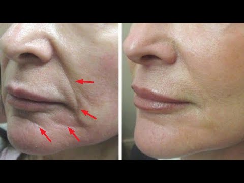 Just 2 skin tightening and face lifting home remedies