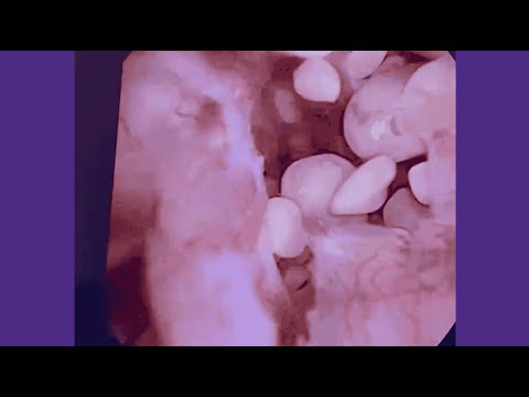 Advancing Kidney Stone Surgery