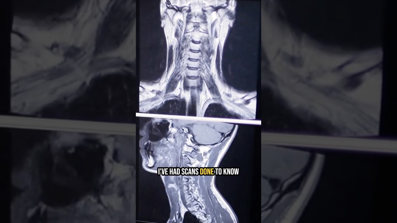 SoftWave TRT for Chronic Neck Pain