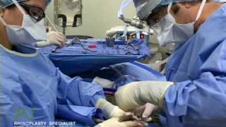 Dr. Nassif’s Closed Rhinoplasty How To – Septoplasty