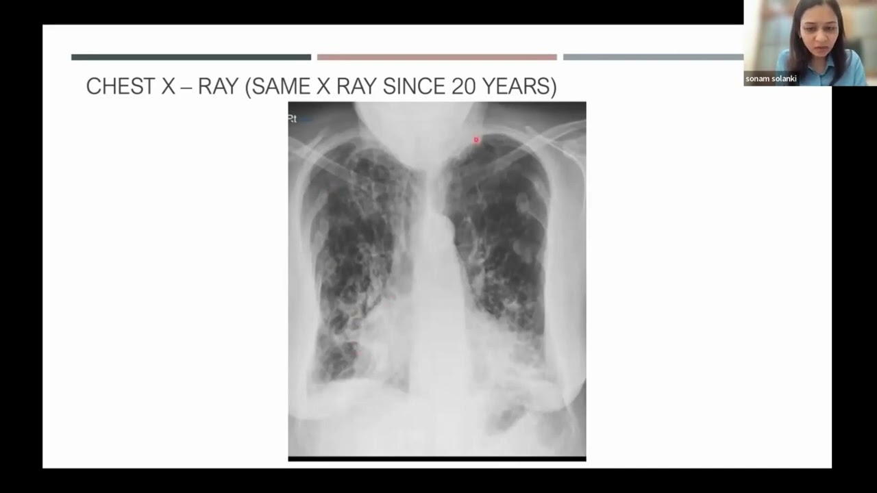 Challenges in Diagnosis of Tuberculosis By Dr SONAM SOLANKI
