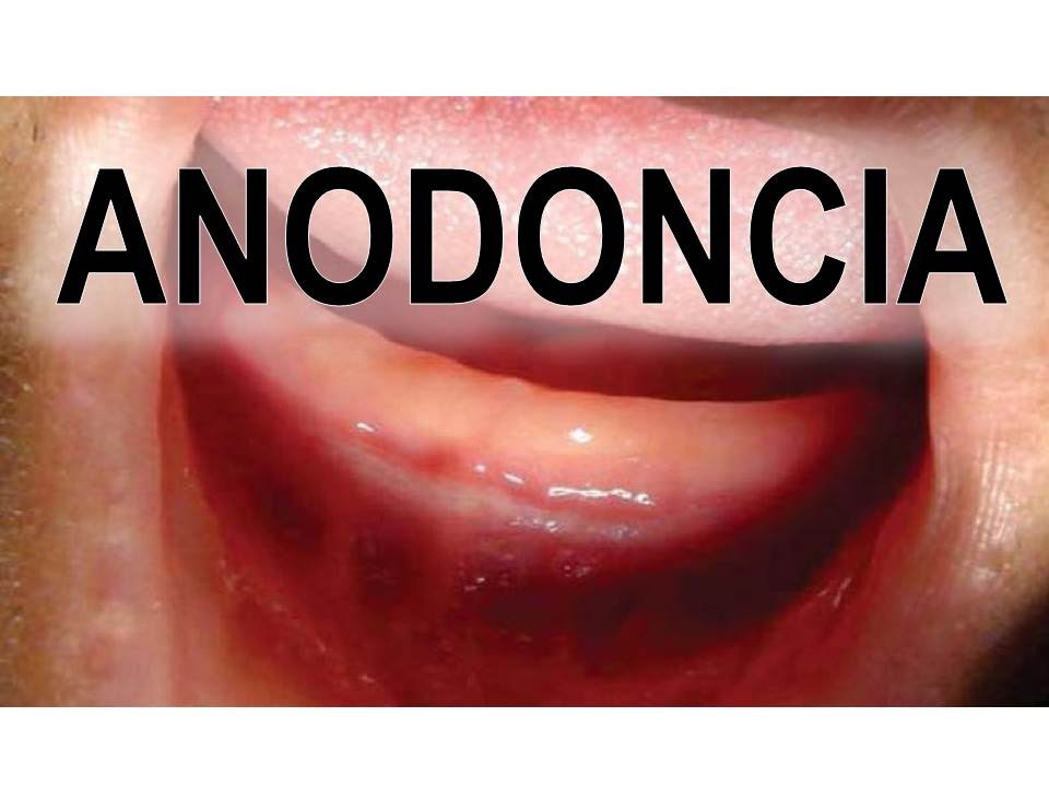 Watch ANODONCIA - AUSENCIA CONGÉNITA DE LA DENTICIÓN Now ANODONCIA - AUSENCIA CONGÉNITA DE LA DENTICIÓN