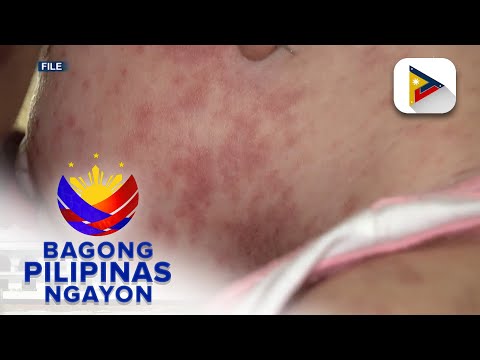 DOH, patuloy ang paalala sa mga magulang na pabakunahan ang anak vs. tigdas at pertussis