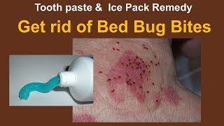 How to get rid of bed bug bites on your skin naturally - Tooth paste &  Ice Pack Remedy