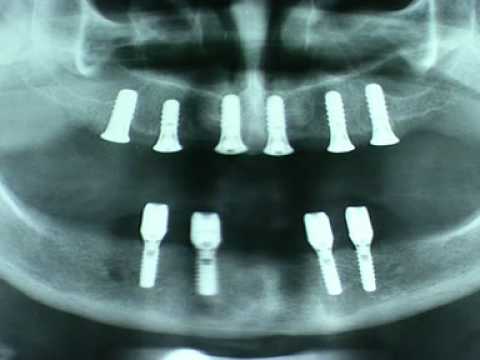Behandlung eines zahnlosen Oberkiefers