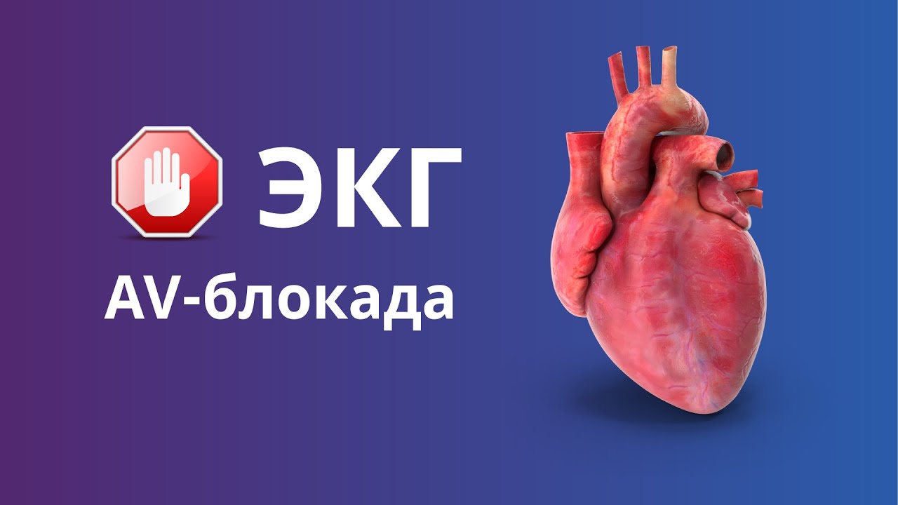 ЭКГ при АВ-блокаде. Анализ экг при ав блокаде 1-й, 2-й и 3-й степени. Клиника и подход к лечению