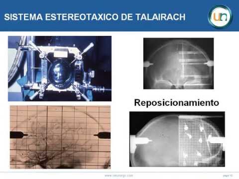GUIA ESTEREOTAXICA DE TALAIRACH