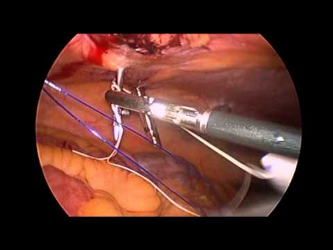 Laparoscopic Repair Of Pfannensteil Incision Induced Hernia 